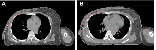 Figure 5 Examples of chest wall CTV delineation for patients undergoing mastectomy. (A) Skin layer, pectoralis layer and area around incision were included in CTV; (B) When rib layer or deep pectoralis layer was invaded by tumor (confirmed by pathology or imaging), the rib layer was included in CTV.