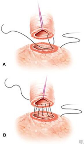 Figure 2 VUA technique with RS. (A) First stitch at 3 o’clock. (B) Posterior anastomotic suture (Image courtesy of ©Stephan Spitzer, medizillu.de; https://www.spitzer-illustration.com/index.php).