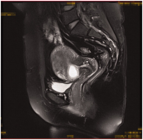 Figure 2. Gestational sac implanted in the previous caesarean scar with empty uterus cavity and cervical canal (sagittal view of the MRI).