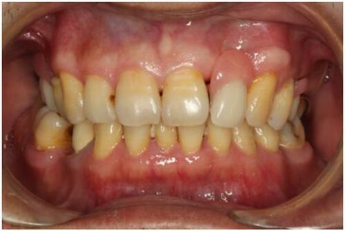 Figure 10 Frontal view with denture.