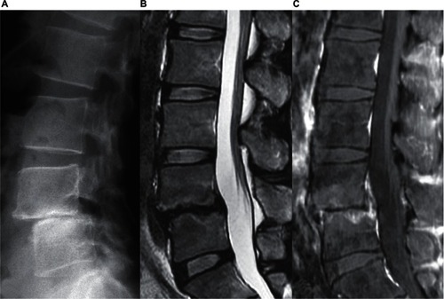 Figure 3 Images 6 months after treatment. A) Plain x-ray. The L4/L5 intervertebral space was lost. B) Plain T2-weighted MRI. The high signal intensity of the L4/L5 intervertebral disc was resolved. C) Gadolinium-enhanced fat-suppressed T1-weighted MRI. Enhancement in the adjacent vertebral bodies remained.