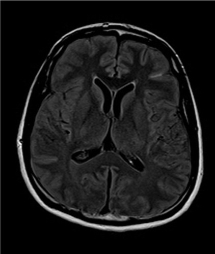 Fig. 2 MRI Brain without contrast.
