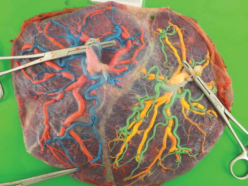 Figure 2. (Full color available online) TTTS placenta treated with the Solomon technique in which a laser coagulation line is clearly visible along the vascular equator.