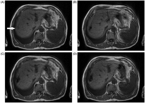 Figure 2. Display of progress of LITT treatment in a 69-year-old patient with liver metastasis from colorectal cancer in segment 8. (A) The T1-weighted axial GRE sequence (FLASH, TE/TR 4.8/119, FA 90°, TA 2 s) shows the metastasis (arrow) before LITT after removal of the magnetic marker between the laser fibres. (B) T1-weighted GRE sequence (same settings) shows the laser fibres 2 min after the start of the LITT procedure. An ellipsoidal-shaped area of hypointensity can be demarcated according to thermal damage. (C) MRI obtained with the same settings after 4 min of ablation. The area of coagulation is enlarging. (D) Image obtained after 9 min: necrosis manifests and an area with a total signal loss can be demarcated.