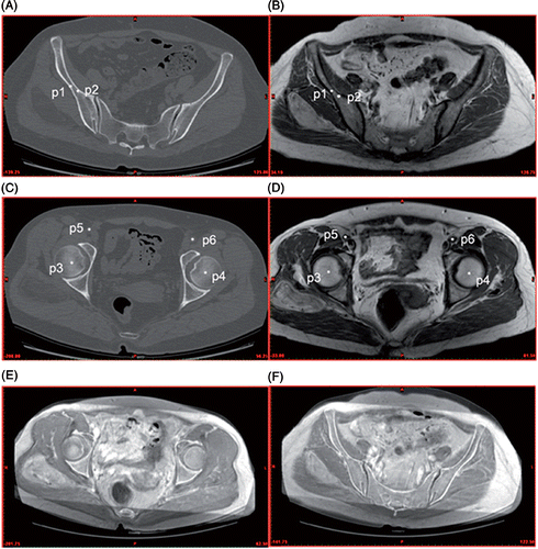 Figure 2. Anatomical landmarks chosen during CT and MRI image fusion. (A) and (C) are CT images, (B) and (D) are MRI images, and (E) and (F) are fused CT/MRI images. p1 and p2 are the right iliac bone islands, p3 and p4 the right and left femoral head centers, and p5 and p6 the right and left external iliac artery centers. According to these corresponding landmarks on the CT and MRI images, all images are aligned with one another in a single fused image dataset.