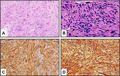 Figure 2 Pathological results of the tumor. (A) Hematoxylin and eosin (H & E) staining showed fascicles of cellular spindle cells within the tumor (200× magnification). (B) The biopsy specimen showed spindle cell proliferation with active mitosis (black arrows) with H & E staining (400× magnification). (C) Immunohistochemical staining showed diffuse and strong DOG-1 expression in the tumor cells (400× magnification). (D) Immunohistochemical staining showed diffuse and strong CD117 expression in the tumor cells (400× magnification).