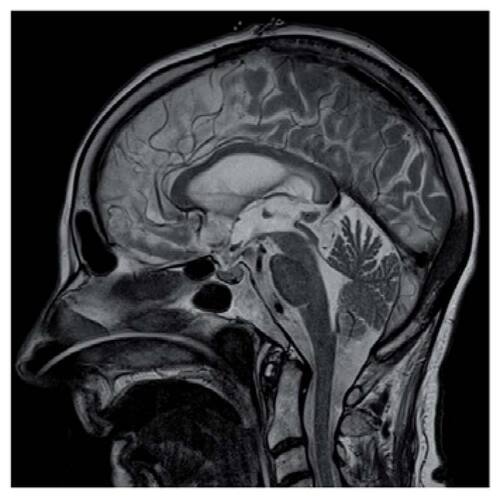 Figure 3. Sagittal MRI brain T2-weighted image showing web within the cerebral aqueduct.