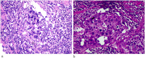 Figure 4. (× 400 HE) The tumor cells exhibited Umbrella or spindle-shaped and were diffusely nests and clumps, cleft formation in partial cells regions, a necrotic area in some areas, with abundant clear cytoplasm, conspicuous nucleoli, mark nuclear atypia, and numerous karyokinesis.