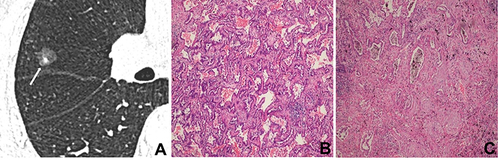 Figure 3 A 55-year-old man with minimally invasive adenocarcinoma. (A) CT image shows a part-solid nodule with regular shape and well-defined margin in the right middle lobe (white long arrow); (B) photomicrograph shows that GGO corresponds to tumor cells growing along the alveolar wall but not completely filling the alveolar space (hematoxylin-eosin stain; original magnification, ×100); (C) photomicrograph shows that a solid component corresponds to invasion of tumor cells and fibrosis (hematoxylin-eosin stain; original magnification, ×100).