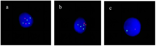 Figure 3 FISH: 1q21/1p32 (a), 13q14.3/(b), and 13q34 RB1(13q14) (c) genes are positive.