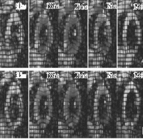 Figure 1. Eulerian circumferential strain overlaid on synthetic tagged images for (a) two-heartbeat breath-hold Fast HARP (b) two-heartbeat non-breath-hold FastHARP.