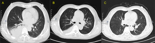 Figure 1 Chest computed tomography examinations on admission, February 12, 2022 (A), six days after admission (B), and three months after discharge home (C). High-density shadow, left lower lobe (B), high-density shadow and segmental atelectasis left lower lobe, small flakes of blurred shadow left upper lobe (C), the shadow disappeared (remission) and re-expansion (left lower lobe).