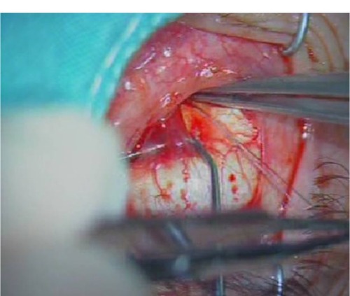 Figure 5 In order for the surface and deeper fibers to enlarge posteriorly, the muscle was held with a clamp and stretched back. During this procedure, when deeper fibers were stretched back, surface fibers and connective tissue were protected gently with large toothless forceps.