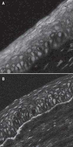 Figure 5 Photomicrograph of cultivated limbal epithelial cells stained for keratin 3 and 12 (A) showing the corneal epithelial phenotype and basement membrane (green) secreted by the growing cells (B).