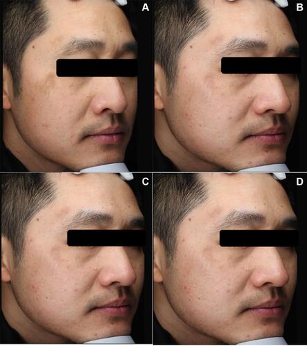 Figure 1 Pictures of the first case. (A) Before treatment, (B) after the second treatment, (C) the color of the original lesions deepened before the third treatment, and (D) 3-year follow-up after the third treatment.