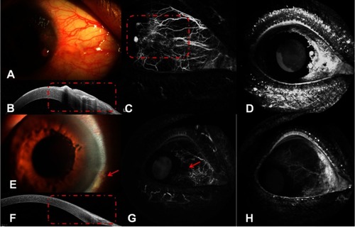 Figure 2 Anterior segment images of Case 1 (right eye). (A) A nodular red tumor involving the cornea and limbus. (B) AS-OCT demonstrated a sharp delineation between normal and abnormal epithelia, a thickened and hyper-reflective epithelium, as well as a plane of cleavage between the lesion and the underlying tissue (red dots). (C) ICGA showed both focal pattern intratumoral vessels and conjunctival feeding vessels clearly (red dots). (D) Leakage from both the tumor and its feeding vessels observed via FA. (E) Complete disappearance of the tumor after treatment, with tiny palpebral fissures remaining (red arrow). (F) No clinical signs of the lesion were present on the AS-OCT image (red dots). (G) Both intratumoral vessels and conjunctival feeding vessels disappeared, and only a patched ischemic region was observed (red arrow) by anterior segment ICGA after treatment. (H) No leakage was found via FA after treatment.Abbreviations: AS-OCT, anterior segment optical coherence tomography; FA, fluorescein angiography; ICGA, conjunctival indocyanine green angiography.