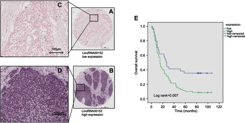 Figure 2 Relationship between LINC00152 expression and clinical features and prognosis in patients with esophageal cancer. LINC00152 expression was detected by ISH in 105 ESCC tissues.Notes: (A and C) Low expression of LINC00152 in ESCC tissue, total score <4, n=19. (B and D) High expression of LINC00152 in ESCC tissue, total score ≥4, n=86. (E) ESCC patients with high LINC00152 expression showed shorter OS compared with patients with low LINC00152 expression by Kaplan–Meier survival curve according to the results of ISH (P=0.007).Abbreviations: ESCC, esophageal squamous cell carcinoma; ISH, in situ hybridization.