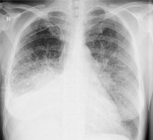 Figure 3 X-ray of chest of second patient – ARDS after lung embolism complicated by lung infection.