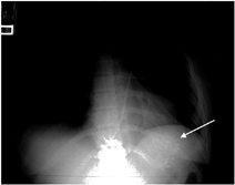 FIG. 1. Medication bezoar identified (arrow) on thoracic X-ray 8 hours after ingestion, persisting after gastric lavage.