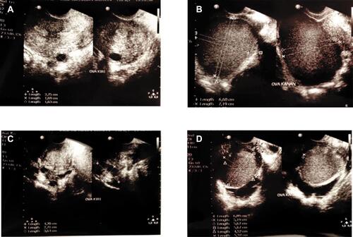 Figure 1 Ovarian transvaginal ultrasound examination from two unilateral endometrioma subjects. (A) is normal ovarium and (B) ovary containing endometrioma from sample E25. (C) is normal ovarium and (D) ovary containing endometrioma from sample E22. Measurement was conducted by using HD11XW 2D Transvaginal Philips ultrasound. The Bland Altman analysis has been carried out prior to study with the result of >80%. Ovarian volume was obtained by calculating the three diameters (d1: longitudinal, d2: anteroposterior, d3: transversal) using the ellipsoid prolate formula V=0.523xd1xd2xd3, then adding up the left and right volumes.