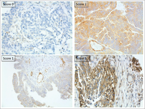 Figure 2. Tumor cells expressing HLA-G shows aberrant HLA-E expression and loss of classical MHC expression (A) HLA-G. (B) HLA-E, score 3. (C) Classical MHC class I HC.