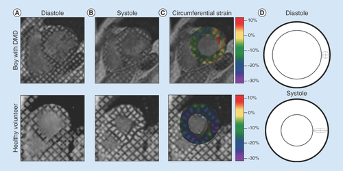 Figure 5.  Left ventricular strain analysis using MRI tagging.By analyzing the deforming tag patterns between (A) diastole and (B) systole, it is possible to create (C) regional quantitative circumferential strain maps. Left ventricular strain describes how a (D) ‘reference’ region (gray circle) in diastole deforms via circumferential shortening (dashed line) and radial thickening (solid line) at peak systole.DMD: Duchenne muscular dystrophy.