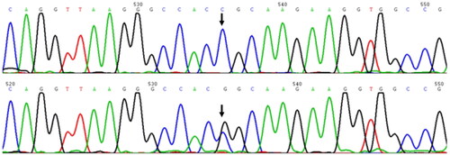 Figure 1. Sanger sequencing chromatograms of the HBA1 gene show the c.178G > C (arrow) mutation in the son (upper) and his mother (lower).
