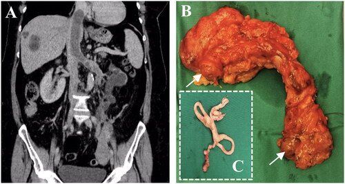 Figure 1. (A) Coronal contrast-enhanced CT image of the abdomen and pelvis showing pelvic tumour, atrophic left kidney with dilated ureter, filling defects of IVC and left renal vein, (B) the removed left kidney with a distended left ovarian vein and left renal vein, the vessels are obliterated with tumour visible at the edges due to venous wall retraction (arrows), (C) the cavoatrial smooth malignant thrombus.