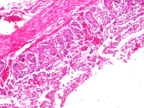 Figure 4.  Group II-section of small intestine showing haemorrhage, degeneration and necrosis of villus epithelium (H&E 100X).
