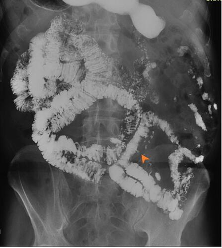 Figure 2 Barium meal follow-through in the follow-up period indicates no evidence of bowel obstruction and absence of enterolith. Multiple small bowel diverticula are noted (Orange arrowhead).