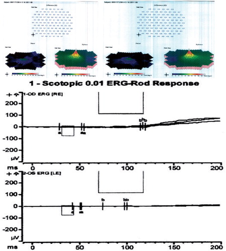 Figure 3. (Top) Results of multifocal ERG. Each image shows the patient's results on the left compared to normal control on the right. Note severe flattening of the mf ERG in both eyes. (Bottom) The full-field ERG revealed undetectable maximal rod responses and severely reduced 30 Hz flicker amplitudes in both eyes, indicating rod and cone photoreceptor loss.