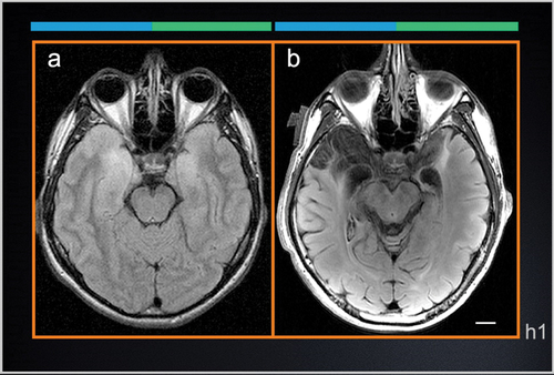 Figure 1. Axial T2-weighted FLAIR scans of A.V.’s brain. a A.V.’s first MRI exam taken at the onset of HSE infection. b Recent scan taken during our study (8 years post-HSE). The early scan shows signal hyperintensities in the temporal lobes consistent with tissue inflammation. Even though the T2-weighted signal is abnormally bright, the shape of the temporal lobes can be delineated clearly, making it possible to evaluate the topography of the lesion with respect to the original anatomy. Areas of T2-weighted hyperintensity in the original clinical scan coincide with the borders of the lesion in the more recent scan. The right hemisphere is marked by the top blue line; the left hemisphere by the green line (see Fig. 2). Scale bars: 1 cm.