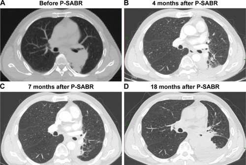 Figure 3 A 56-year-old male with squamous cell cancer of the left lung (T3N2M0). Before (A) and 4 months (B), 7 months (C), and 18 months (D) after P-SABR (SABR plans: 6 Gy/f×4 f, CRT plans: 2.2 Gy/f×26 f→ Dose: GTVb 81.2 Gy/PTV 69.2 Gy/30 f).