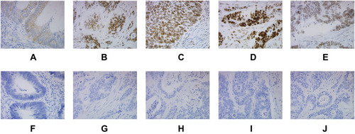 Figure 1 Expression of HER2, MLH1, MSH2, MSH6 and PMS2 markers in CRC tissues (×400). (A) HER2 (+); (B) MLH1 (+); (C) MSH2 (+); (D) MSH6 (+); (E) PMS2 (+); (F) HER2 (-); (G) MLH1 (-); (H) MSH2 (-); (I) MSH6 (-); (J) PMS2 (-).