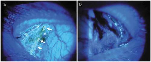 Figure 3. A. Slit lamp photograph of the left palpebral lobe of the main lacrimal gland in a 26-year-old male demonstrates three excretory openings with surrounding fluorescein washout area (marked with arrow, on dynamic assessment of tear secretion), seen under cobalt blue light; B. whereas a 56-year-old male patient with Sjogren’s syndrome demonstrates reduction in the size of the gland with no visible secretory openings.