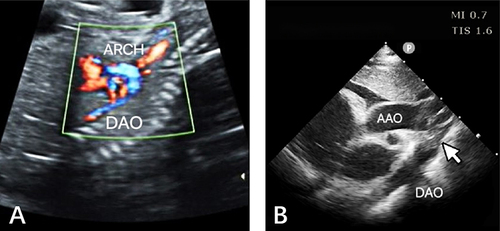 Figure 1 (A) At 24 weeks pregnant. Suprasternal view of aortic arch shows the wall continuity from the aortic arch to the descending aorta is intact. The green box represents the Color Doppler sampling position. Blue blood flow signal shows no evident anomaly in blood flow of the aortic arch and descending segment. (B) 15 days after birth. There is stenosis in the aortic arch starting from the opening of the LCCA, with the distal end being a blind end. There is stenosis at the opening of the LSCA. White arrow represents the distal end of the transverse aortic arch was a blind end.