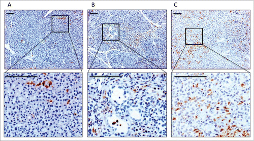 Figure 1. Myeloid cell infiltration into murine pancreatic tissue. Immunhistochemical staining for CD68 in representative pancreatic tissues of LSL-KrasG12D/+; LSL-Trp53R172H/+; Pdx-1-Cre mice. (A) Normal area. (B) PanIN lesion. (C) Invasive PDAC. Bars indicate 100 μm.