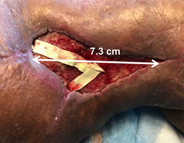 Figure 5 Tumor bed two weeks post surgery.