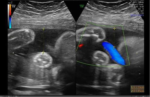 Figure 3 Example B of the assessment of amniotic fluid volume using gray scale on the L side of the screen and color Doppler on the R side of the screen and measurement of the amniotic fluid pocket.