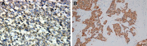 Figure 5 The tumor cells exhibited positive immunoreactivity for (A) CD56 and (B) synaptophysin (magnification: 200×).