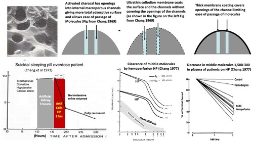 Figure 5. Upper: Activated charcoal is microporous with openings from the surface allowing the easy entrance of larger molecules in the middle molecular range. Ultrathin collodion membrane coating does not obstruct the opening. Thick membrane will obstruct the openings. Lower left: Clinical result in a suicidal overdose patient treated by haemodialysis then by hemoperfusion. Lower centre and lower right: Separate study on a group of renal failure patients using hemoperfusion. The clearance and decrease of middle molecules is much higher compared to haemodialysis at that time. (From Chang [Citation28] with written copyright permission to reproduce this figure from the publisher World Science Publisher.)