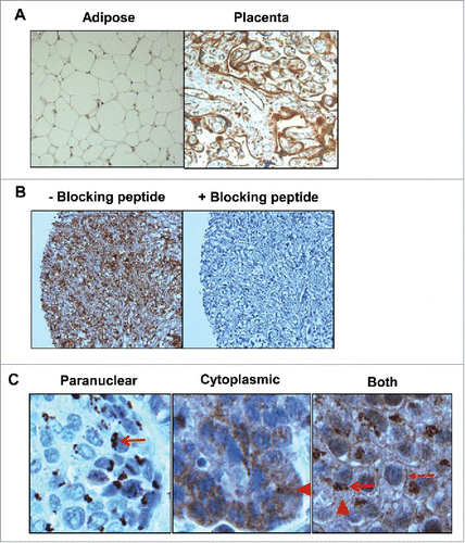 Figure 1. Determination of specificity for IL-5Rα staining by immunohistochemistry (IHC). (A) IL-5Rα-negative and -positive adipose and placental tissue, respectively, were stained in the presence of the IL-5Rα-specific polyclonal antibody. (B) IL-5Rα-positive tissue was stained with the IL-5Rα-specific polyclonal antibody in the presence of 100-fold excess blocking peptide. (C) IL-5Rα staining of bladder cancer specimens is predominantly paranuclear, cytoplasmic, and plasma membrane, respectively (arrow), (arrowhead), and (dashed arrow).