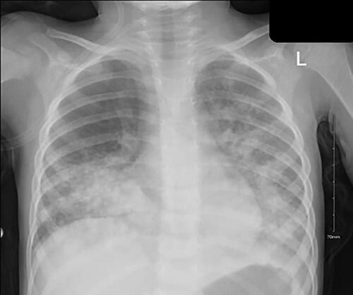 Figure 1. Chest radiograph on day one on second admission.