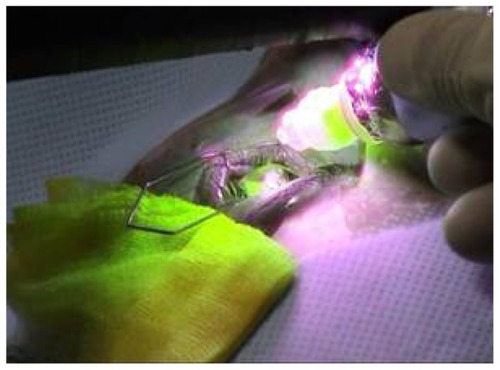 Figure 4 Performing collagen crosslinking in a progressive keratoconus patient with the modified ultraviolet A lamp and the self-made riboflavin 0.1% solution at 3.5 cm from the cornea.