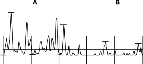 Figure 1 Profilometry of the skin surface in a diabetic patient. The sample comprises an untreated xerotic part (A) and a contiguous field (B) treated for 5 days with a urea-based cosmetic formulation.