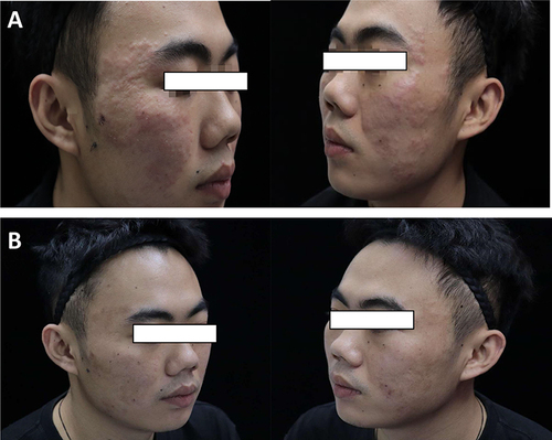 Figure 1 (A) The image shows facial patchy brownish-black spots, with several lentil-sized follicular red papules distributed on top. (B) The skin lesion on the posterior area has regressed after treatment.