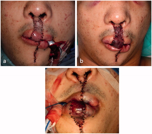 Figure 1. (a) At the completion of surgery, (b) 6 h after surgery and (c) the flap was returned to the lower lip.