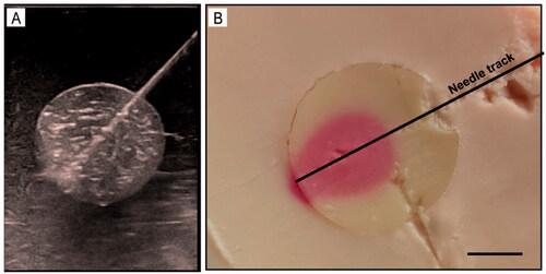 Figure 9. (A) US-guided tumor puncture. (B) The gross specimen of the phantom model after MWA. Bar = 1 cm.