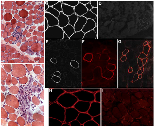 Figure 1 Muscle histopathology and dystrophin immunohistochemistry in DMD.
