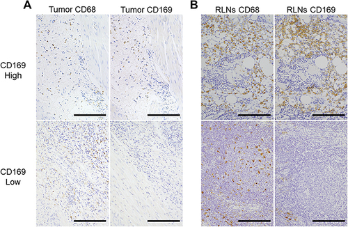 Figure 1 Immunohistochemistry (IHC) for CD68 and CD169 in the bladder tumor and RLNs. Scale bar = 200 µm. Tumors (A) and RLNs (B) were stained for CD68 (left columns) and CD169 (right columns). In both (A) and (B), the pair of upper panels is the CD169 High case, and the pair of lower panels is the CD169 Low case.